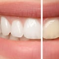 Can I Use Professional Teeth Whitening If I Have Sensitive Teeth?