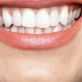 How Often Should You Whiten Your Teeth Professionally? A Professional's Guide