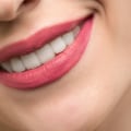 Choosing the Right Teeth Whitening Dentist in London: What You Need to Know
