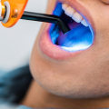 What Are the Best Alternatives to Professional Teeth Whitening Treatments?