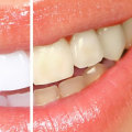 What Teeth Cannot Be Whitened? A Comprehensive Guide