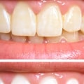 Maintaining White Teeth: Is Professional Treatment the Best Option?