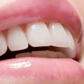 Maintaining White Teeth After Professional Treatment: Supplements to the Rescue