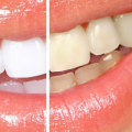 What are the Side Effects of Teeth Whitening? A Comprehensive Guide