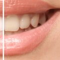 How to Whiten Yellow Teeth: The Best Solutions for a Brighter Smile