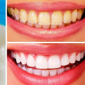 Natural Ways to Whiten Your Teeth