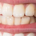 How to Keep Your Teeth White and Healthy After Professional Treatment