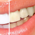 How to Keep Your Teeth White and Bright After Professional Whitening Treatment