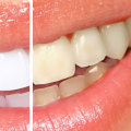 Maintaining a Bright White Smile After Professional Teeth Whitening
