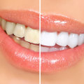 Cosmetic Dentistry In Waco: Enhancing Your Smile With Teeth Whitening
