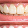 Does Teeth Whitening Damage Enamel? An Expert's Perspective