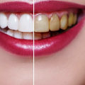 How Often Should You Brighten Your Smile with Teeth Whitening?