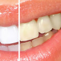 Maintaining a Bright Smile After Professional Teeth Whitening: Tips and Tricks