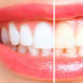 How Long Does Teeth Whitening Take to Work? A Comprehensive Guide