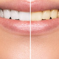 How to Safely Whiten Your Teeth: Expert Tips and Advice