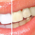Maintaining a Bright Smile After Professional Teeth Whitening