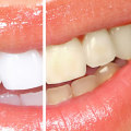 Does Professional Teeth Whitening Outshine Mouthwash Whitening Results?