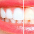Can Baking Soda Whiten Your Teeth? Expert Advice on How to Brighten Your Smile