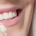 The Finishing Touch: Porcelain Veneers In Spring, TX, To Complement Your Professional Teeth Whitening Journey