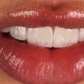 The Finishing Touch: Porcelain Veneers In Spring, TX, To Complement Your Professional Teeth Whitening Journey