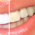 Maintaining a Bright Smile After Professional Teeth Whitening