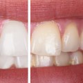 The Benefits of Professional Teeth Whitening for Oral Hygiene