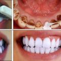 Say Goodbye To Yellow Teeth: How A Dentist In Monroe, LA Can Help With Teeth Whitening