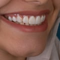 When is it Safe to Brighten Your Teeth?