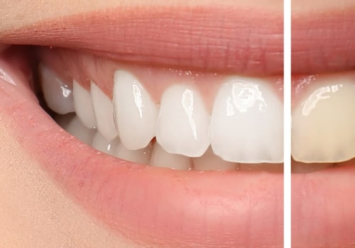 Can I Use Professional Teeth Whitening If I Have Sensitive Teeth?