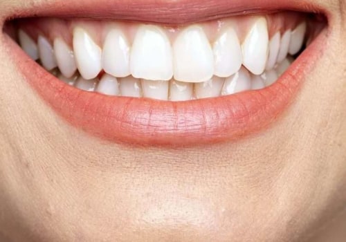 How Often Should You Whiten Your Teeth Professionally? A Professional's Guide