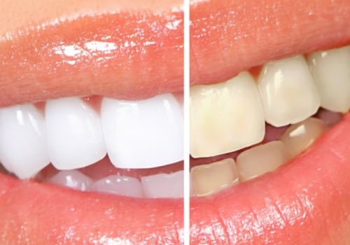 What Teeth Cannot Be Whitened? A Comprehensive Guide