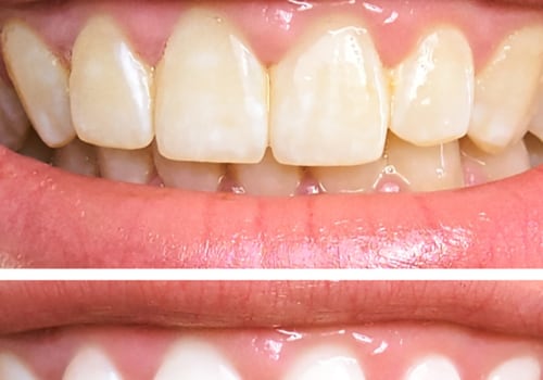 Maintaining White Teeth: Is Professional Treatment the Best Option?