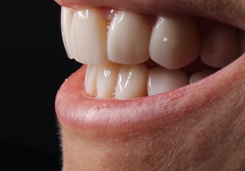 Can I Whiten My Teeth with Crowns or Veneers? - A Guide for Teeth Whitening