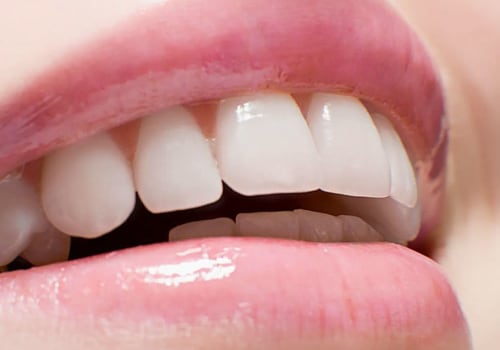 Maintaining White Teeth After Professional Treatment: Supplements to the Rescue