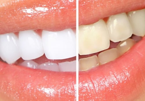 What are the Side Effects of Teeth Whitening? A Comprehensive Guide