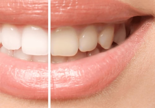 How to Whiten Yellow Teeth: The Best Solutions for a Brighter Smile