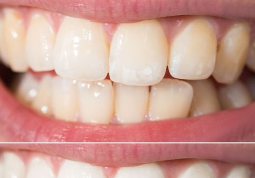 How to Keep Your Teeth White and Healthy After Professional Treatment