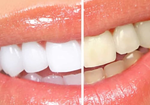 How to Keep Your Teeth White and Bright After Professional Whitening Treatment