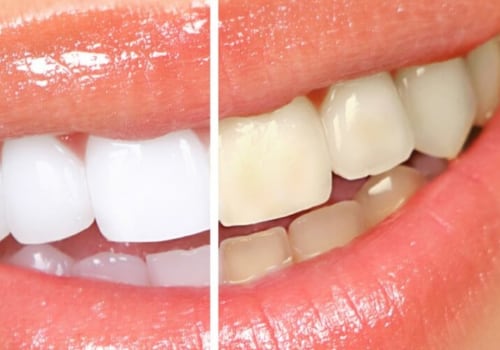Maintaining a Bright White Smile After Professional Teeth Whitening