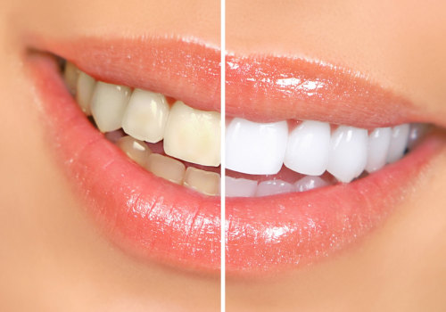 Cosmetic Dentistry In Waco: Enhancing Your Smile With Teeth Whitening