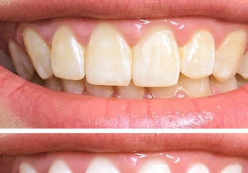 Does Teeth Whitening Damage Enamel? An Expert's Perspective