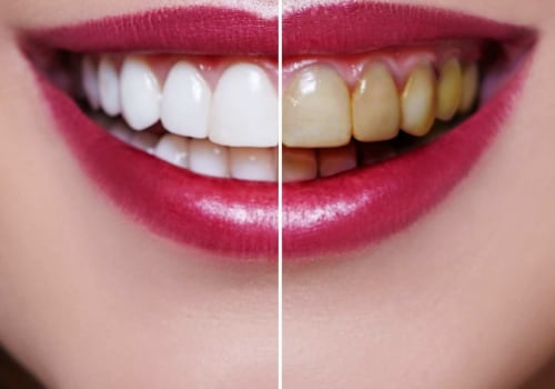 How Often Should You Brighten Your Smile with Teeth Whitening?