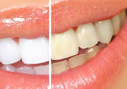 Maintaining a Bright Smile After Professional Teeth Whitening: Tips and Tricks