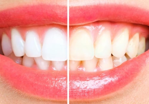 How Long Does Teeth Whitening Take to Work? A Comprehensive Guide