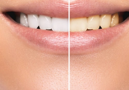 How to Safely Whiten Your Teeth: Expert Tips and Advice