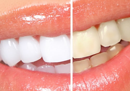 Does Professional Teeth Whitening Outshine Mouthwash Whitening Results?
