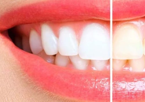 Can Baking Soda Whiten Your Teeth? Expert Advice on How to Brighten Your Smile