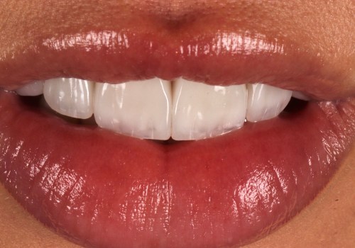 The Finishing Touch: Porcelain Veneers In Spring, TX, To Complement Your Professional Teeth Whitening Journey
