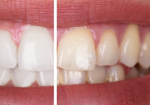 The Benefits of Professional Teeth Whitening for Oral Hygiene