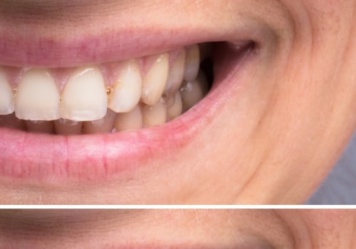 The Best Over-the-Counter Teeth Whitening Solutions: A Comprehensive Guide